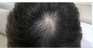 Da đầu trước khi gội — minh hoạ lộ trình chăm sóc tại Lian