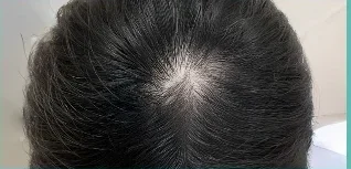 Da đầu sau 30 lần — minh hoạ lộ trình chăm sóc tại Lian